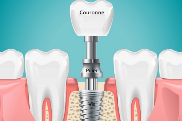 LES DIFFÉRENTES PIÈCES D’UN IMPLANT