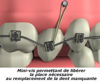 Les mini-vis orthodontiques